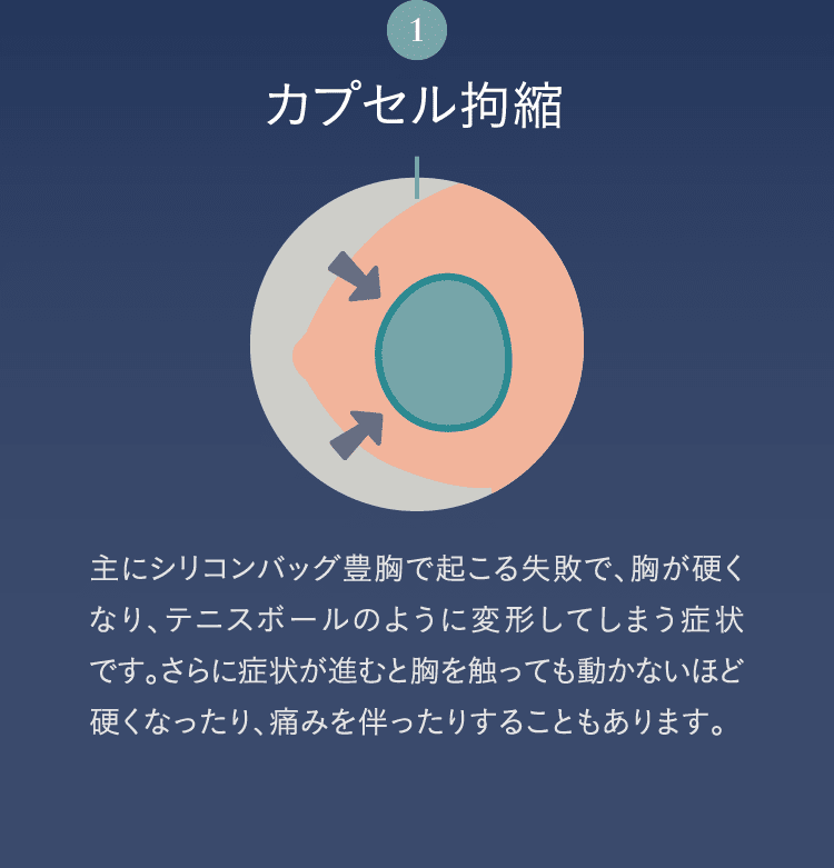 1. カプセル拘縮 | 主にシリコンバッグ豊胸で起こる失敗で、胸が硬くなり、テニスボールのように変形してしまう症状です。さらに症状が進むと胸を触っても動かないほど硬くなったり、痛みを伴ったりすることもあります。
