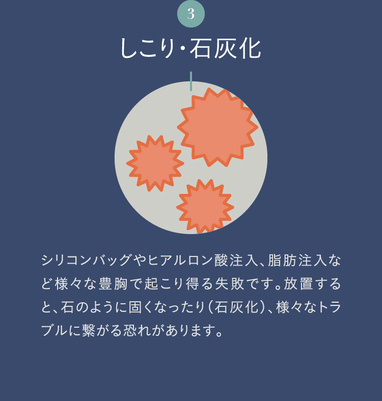 3. しこり・石灰化 | シリコンバッグやヒアルロン酸注入、脂肪注入など様々な豊胸で起こり得る失敗です。放置すると、石のように固くなったり（石灰化）、様々なトラブルに繋がる恐れがあります。