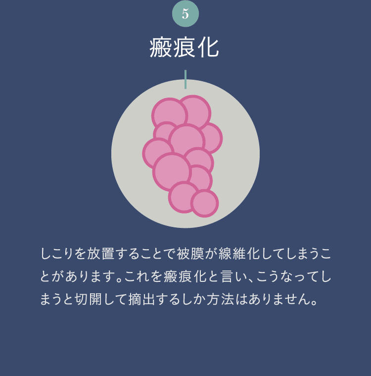 5. 瘢痕化 | しこりを放置することで被膜が線維化してしまうことがあります。これを瘢痕化と言い、こうなってしまうと切開して摘出するしか方法はありません。