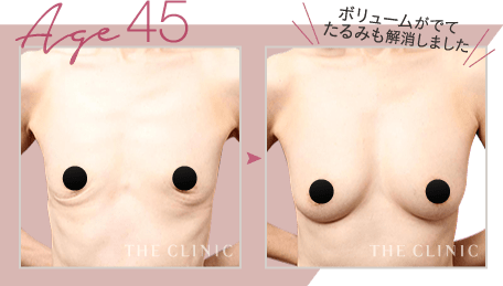 Age.45