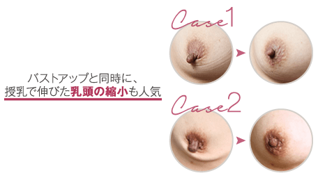 バストアップと同時に、授乳で伸びた乳頭の縮小も大人気。