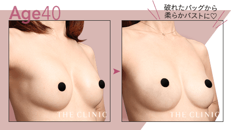Age.40 破れたバッグから柔らかバストに