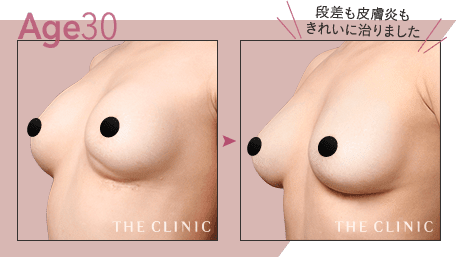 Age.30 段差も皮膚炎もきれいに治りました