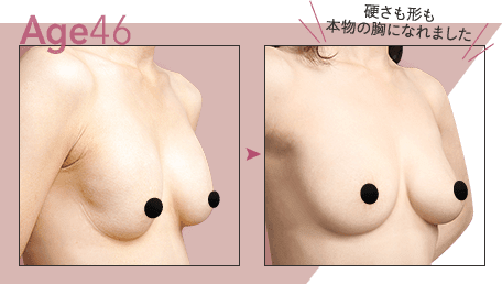 Age.46 硬さも形も本物の胸になれました