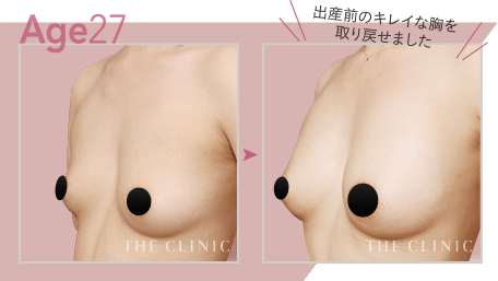 Age27 出産前のキレイな胸を取り戻せました