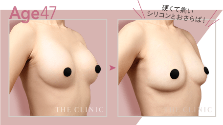 Age47 硬くて痛いシリコンとおさらば！