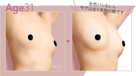 Age31 全然バレないし今では全く本物の胸です