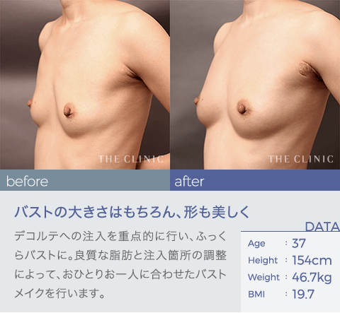 バスト の症例2