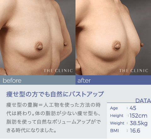 バスト の症例3