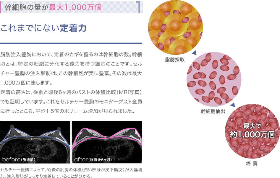 特徴1 幹細胞の量が最大1,000万個 | これまでにない定着力 | 脂肪注入豊胸において、定着のカギを握るのは幹細胞の数。幹細胞とは、特定の細胞に分化する能力を持つ細胞のことです。セルチャー豊胸の注入脂肪は、この幹細胞が実に豊富。その数は最大1,000万個に達します。定着の高さは、従前と術後6ヶ月のバストの体積比較（MRI写真）でも証明しています。これをセルチャー豊胸のモニターゲスト全員に行ったところ、平均1.5倍のボリューム増加が見られました。