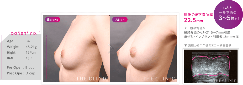 バスト の症例1