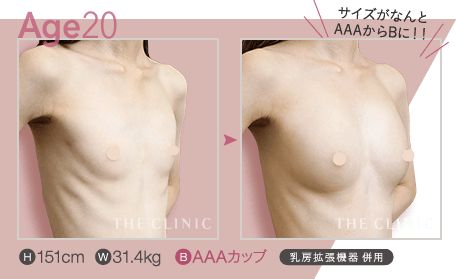 Age.20 | H: 151cm / W: 31.4kg / B: AAAカップ ／ BRAVA併用