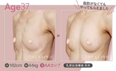 Age.37 | H: 162cm / W: 44kg / B: AAカップ ／ BRAVA併用